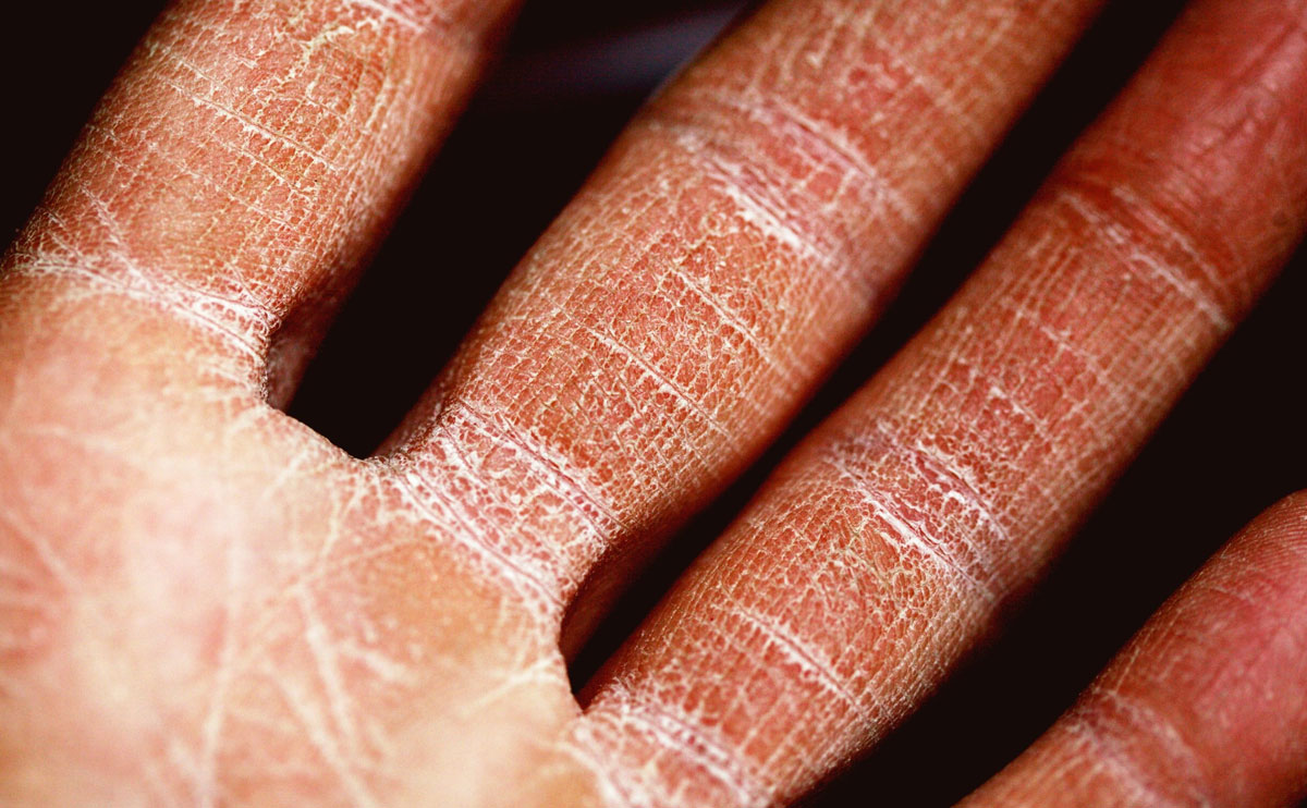 علت خشکی پوست دست