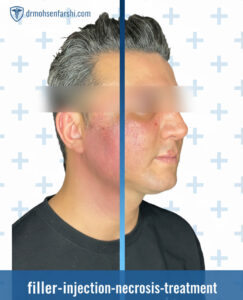 درمان نکروز