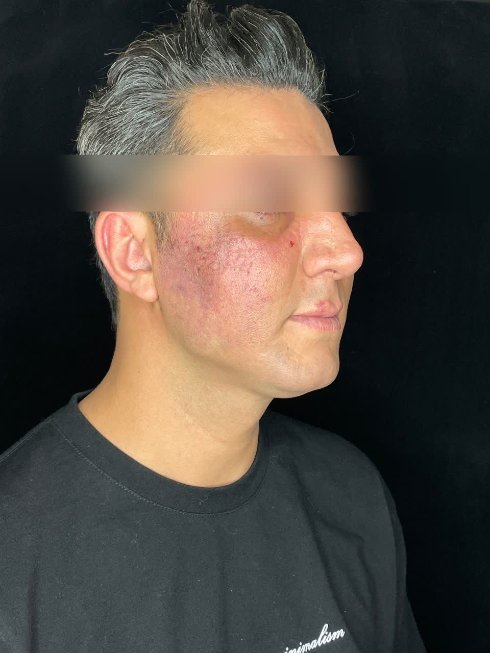 درمان نکروز