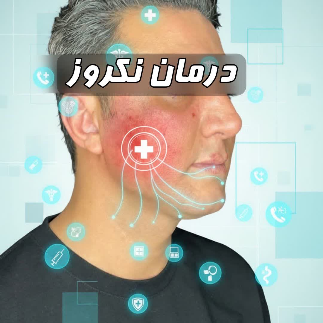 درمان نکروز