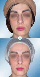 تزریق چربی صورت طبیعی در اصفهان